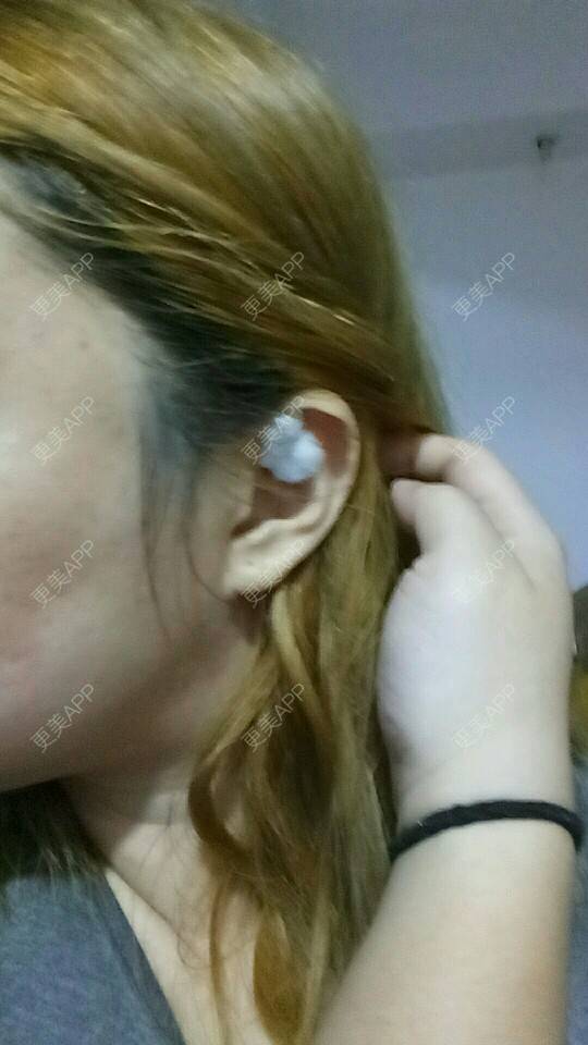 更美 - 胡涂的自体脂肪全面部填充经验 | 轮廓套餐 | 双眼皮 | 假体隆胸 | 冷光美白 | 激光去眼袋 | 玻尿酸 | 自体脂肪全面部填充 | 祛斑祛色素 | 自体脂肪隆胸 | 除皱瘦脸 | 吸脂瘦脸 | 埋线提升 | 深圳