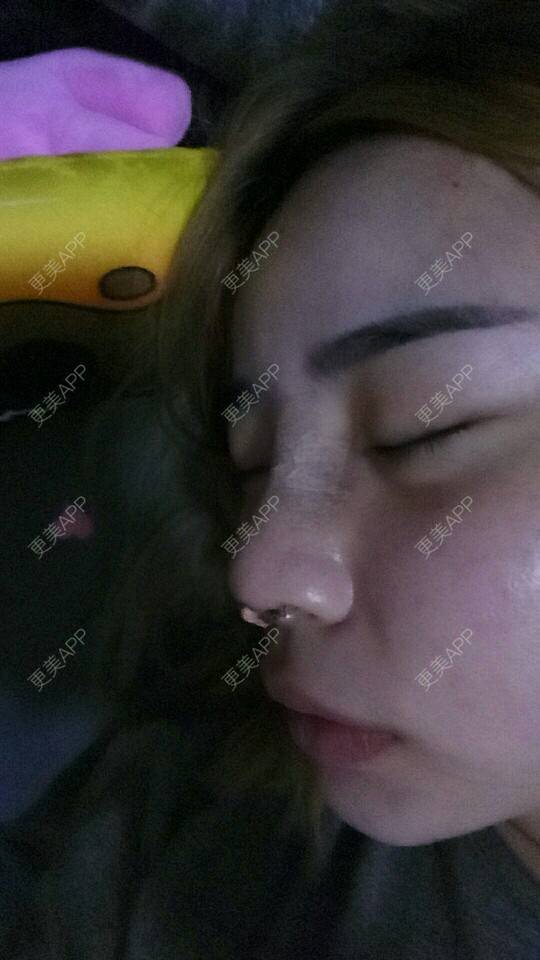 更美 - 胡涂的自体脂肪全面部填充经验 | 轮廓套餐 | 双眼皮 | 假体隆胸 | 冷光美白 | 激光去眼袋 | 玻尿酸 | 自体脂肪全面部填充 | 祛斑祛色素 | 自体脂肪隆胸 | 除皱瘦脸 | 吸脂瘦脸 | 埋线提升 | 深圳