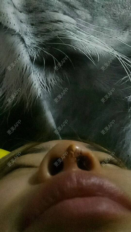 更美 - 胡涂的自体脂肪全面部填充经验 | 轮廓套餐 | 双眼皮 | 假体隆胸 | 冷光美白 | 激光去眼袋 | 玻尿酸 | 自体脂肪全面部填充 | 祛斑祛色素 | 自体脂肪隆胸 | 除皱瘦脸 | 吸脂瘦脸 | 埋线提升 | 深圳