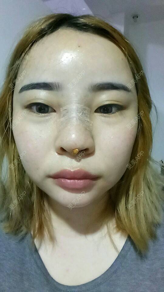 更美 - 胡涂的自体脂肪全面部填充经验 | 轮廓套餐 | 双眼皮 | 假体隆胸 | 冷光美白 | 激光去眼袋 | 玻尿酸 | 自体脂肪全面部填充 | 祛斑祛色素 | 自体脂肪隆胸 | 除皱瘦脸 | 吸脂瘦脸 | 埋线提升 | 深圳