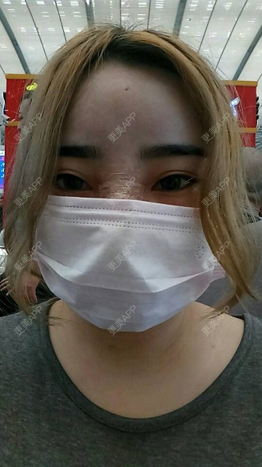 更美 - 胡涂的自体脂肪全面部填充经验 | 轮廓套餐 | 双眼皮 | 假体隆胸 | 冷光美白 | 激光去眼袋 | 玻尿酸 | 自体脂肪全面部填充 | 祛斑祛色素 | 自体脂肪隆胸 | 除皱瘦脸 | 吸脂瘦脸 | 埋线提升 | 深圳