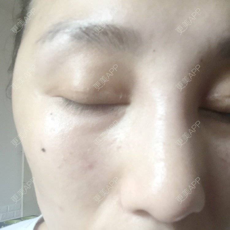更美 - WWmum的玻尿酸经验 | 成都 | 重庆 | 自体脂肪丰太阳穴 | 杭州 | 鼻部膨体假体取出 | 苏州 | 上海 | 祛黑眼圈 | 除皱瘦脸 | 埋线提升 | 广州 | 美白嫩肤 | 青岛 | 玻尿酸
