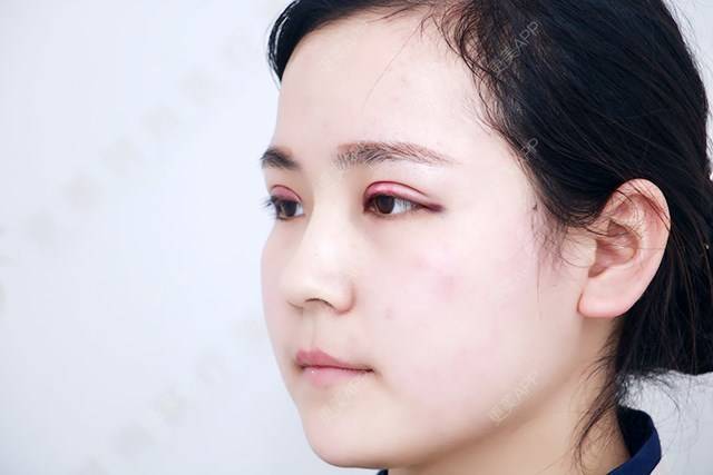 去皮去脂翘睫郑州￥3980起【全切双眼皮】【切开双眼皮】小清新双眼皮