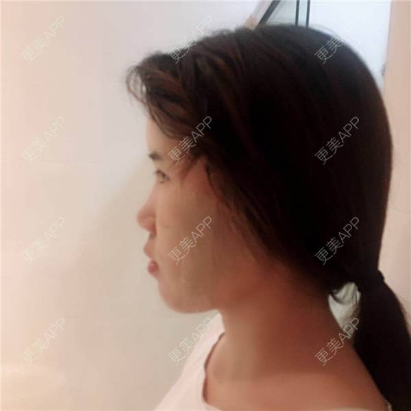更美 - 王弈婷 医生的自体脂肪全面部填充经验 | 自体脂肪全面部填充