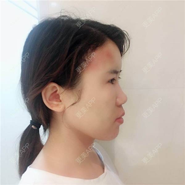 更美 - 王弈婷 医生的自体脂肪全面部填充经验 | 自体脂肪全面部填充