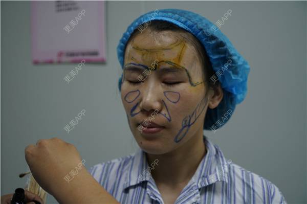 更美 - 王弈婷 医生的自体脂肪全面部填充经验 | 自体脂肪全面部填充