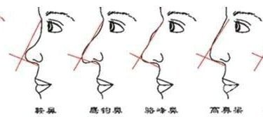 鼻形态修复