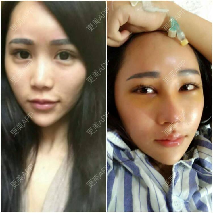 肋软骨隆鼻对比图_更美用户yv4mnaj7cv肋软骨隆鼻对比图_术后92天__更