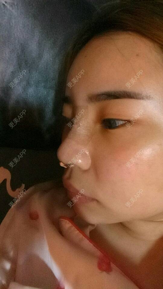 更美 - 胡涂的鼻部多项经验 | 深圳 | 假体隆胸 | 鼻部多项