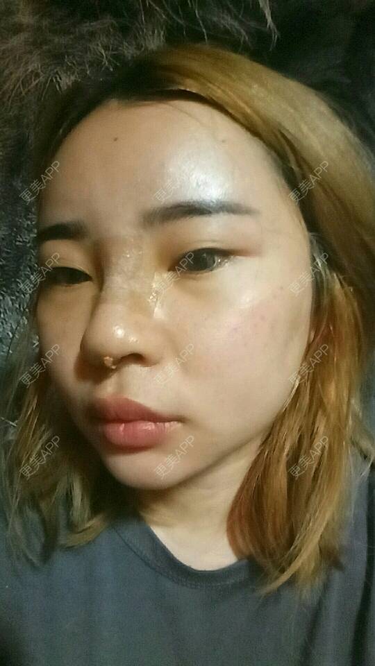 更美 - 胡涂的鼻部多项经验 | 深圳 | 假体隆胸 | 鼻部多项