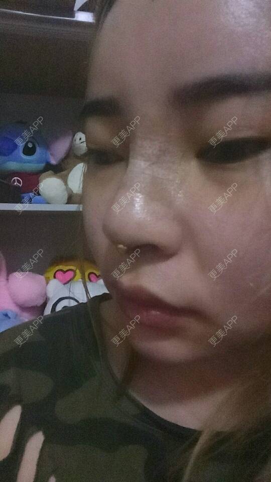 更美 - 胡涂的鼻部多项经验 | 深圳 | 假体隆胸 | 鼻部多项