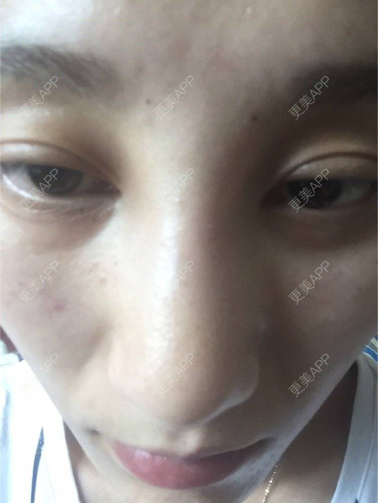 更美 - WWmum的玻尿酸经验 | 成都 | 重庆 | 自体脂肪丰太阳穴 | 杭州 | 鼻部膨体假体取出 | 苏州 | 上海 | 祛黑眼圈 | 除皱瘦脸 | 埋线提升 | 广州 | 美白嫩肤 | 青岛 | 玻尿酸