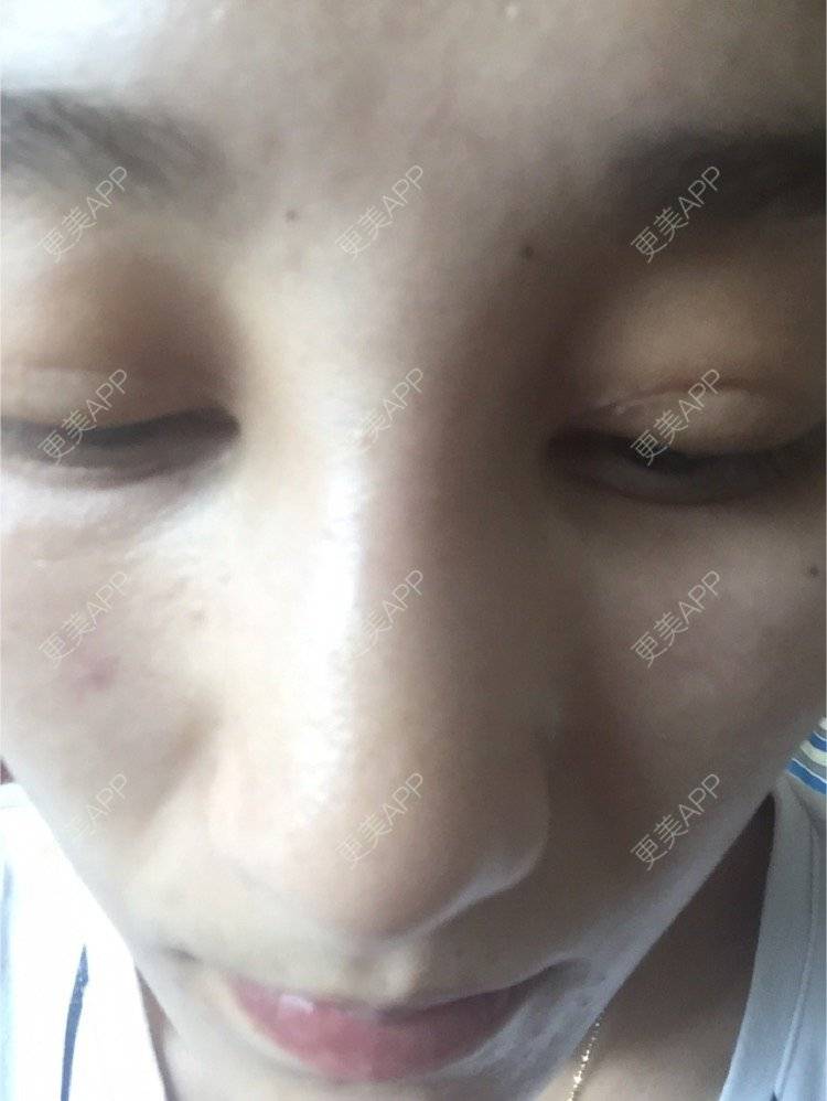 更美 - WWmum的玻尿酸经验 | 成都 | 重庆 | 自体脂肪丰太阳穴 | 杭州 | 鼻部膨体假体取出 | 苏州 | 上海 | 祛黑眼圈 | 除皱瘦脸 | 埋线提升 | 广州 | 美白嫩肤 | 青岛 | 玻尿酸