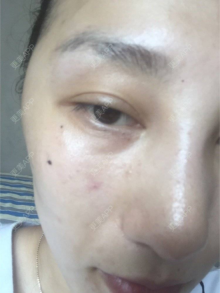 更美 - WWmum的玻尿酸经验 | 成都 | 重庆 | 自体脂肪丰太阳穴 | 杭州 | 鼻部膨体假体取出 | 苏州 | 上海 | 祛黑眼圈 | 除皱瘦脸 | 埋线提升 | 广州 | 美白嫩肤 | 青岛 | 玻尿酸