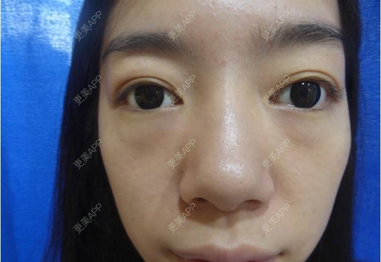 更美 - zxy520？的祛眼袋经验 | 祛眼袋 | 宁波 | 杭州 | 点阵激光 | 深圳 | 双眼皮