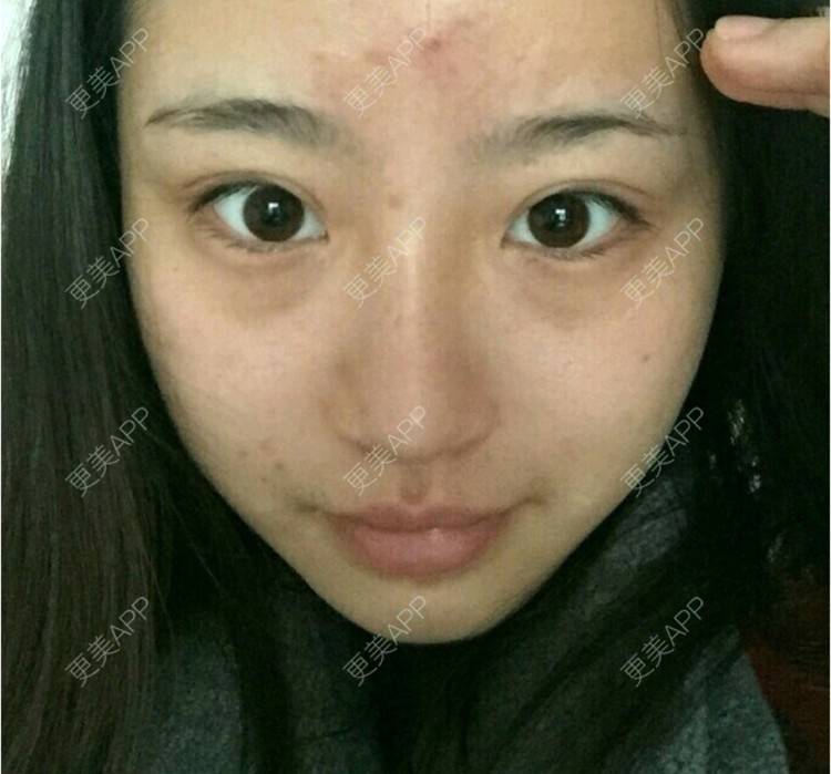 更美 - 像昨天你共我7的祛眼袋经验 | 祛眼袋 | 宁波 | 杭州 | 北京 | 点阵激光 | 深圳 | 激光淡斑 | 双眼皮