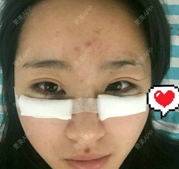 更美 - 像昨天你共我7的祛眼袋经验 | 祛眼袋 | 宁波 | 杭州 | 北京 | 点阵激光 | 深圳 | 激光淡斑 | 双眼皮