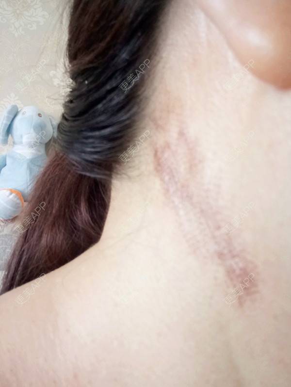 雨过天晴的激光淡疤日记