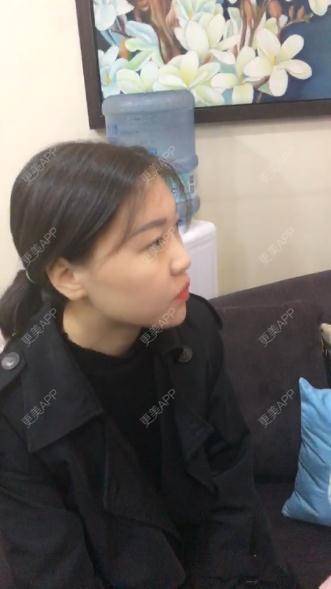 更美 - 更美用户r1mCniLjEb的埋线隆鼻经验 | 怀化 | 埋线隆鼻