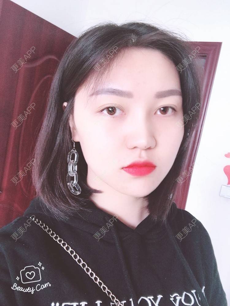更美 - 更美用户r1mCniLjEb的埋线隆鼻经验 | 怀化 | 埋线隆鼻