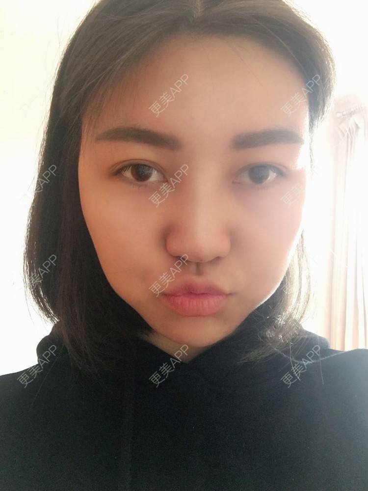 更美 - 更美用户r1mCniLjEb的埋线隆鼻经验 | 怀化 | 埋线隆鼻