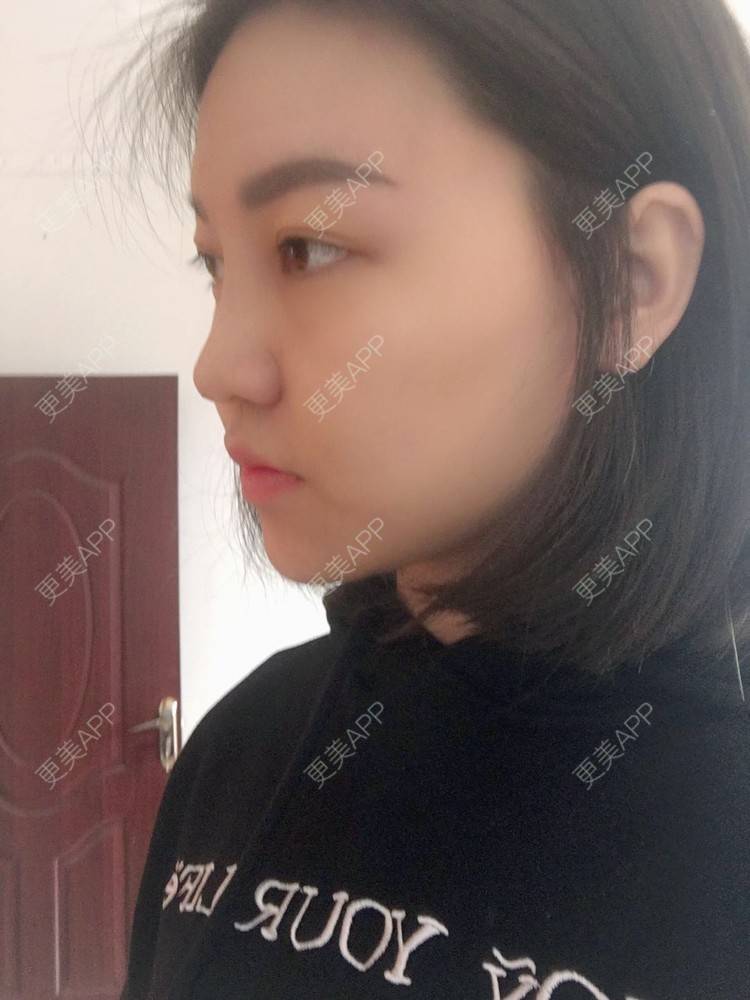 更美 - 更美用户r1mCniLjEb的埋线隆鼻经验 | 怀化 | 埋线隆鼻