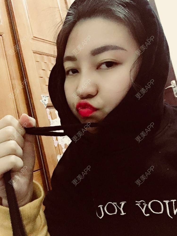 更美 - 更美用户r1mCniLjEb的埋线隆鼻经验 | 怀化 | 埋线隆鼻