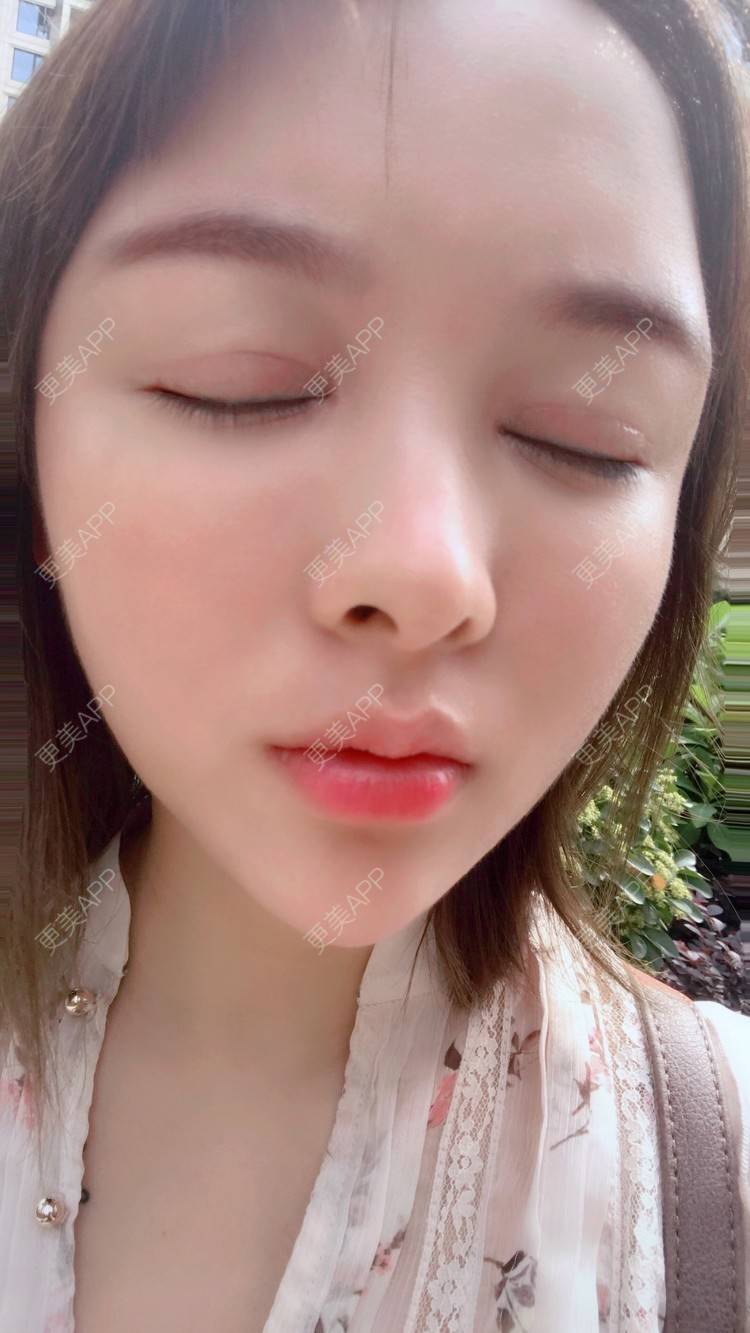 冰冷温柔的双眼皮修复日记