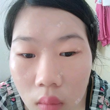全切双眼皮