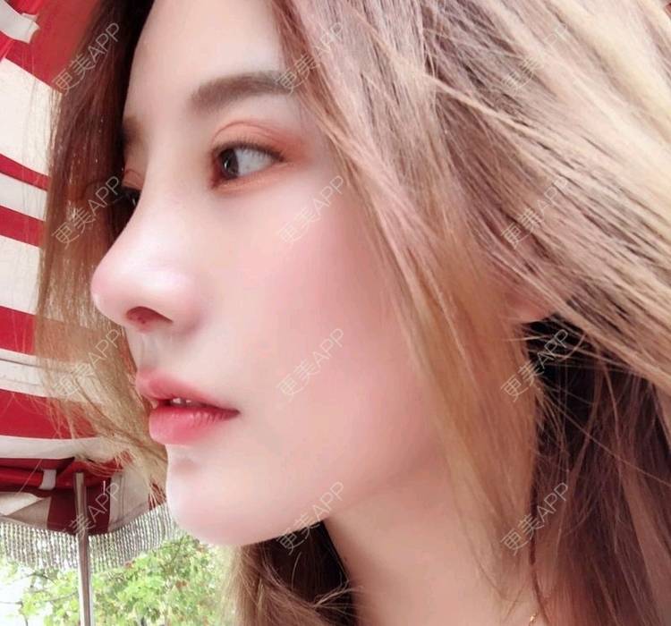 78钻石女王心的膨体隆鼻日记