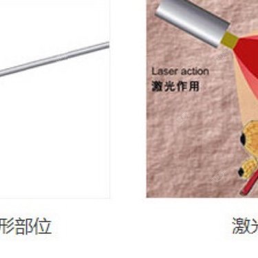 光纤溶脂