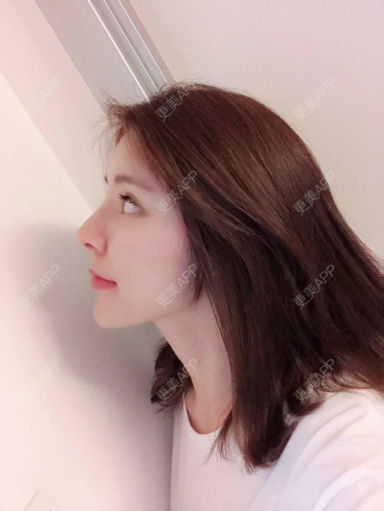 更美 - 罗莉 医生的鼻部多项经验 | 福州 | 鼻部多项