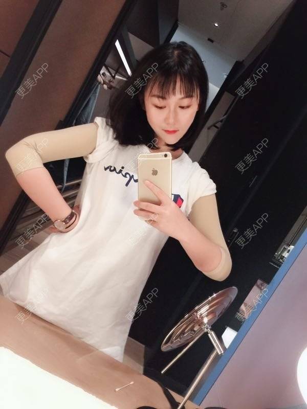 圆m的手臂吸脂日记