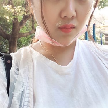 鼻部硅胶假体取出