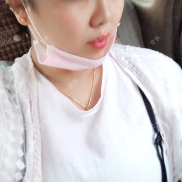 鼻部硅胶假体取出
