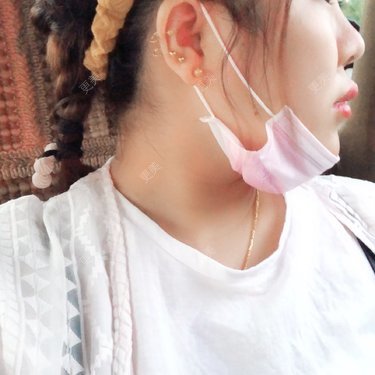 鼻部硅胶假体取出