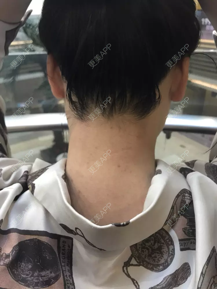 更美 - 临寒★独自开的激光脱发际线经验 | 激光脱发际线 | 深圳