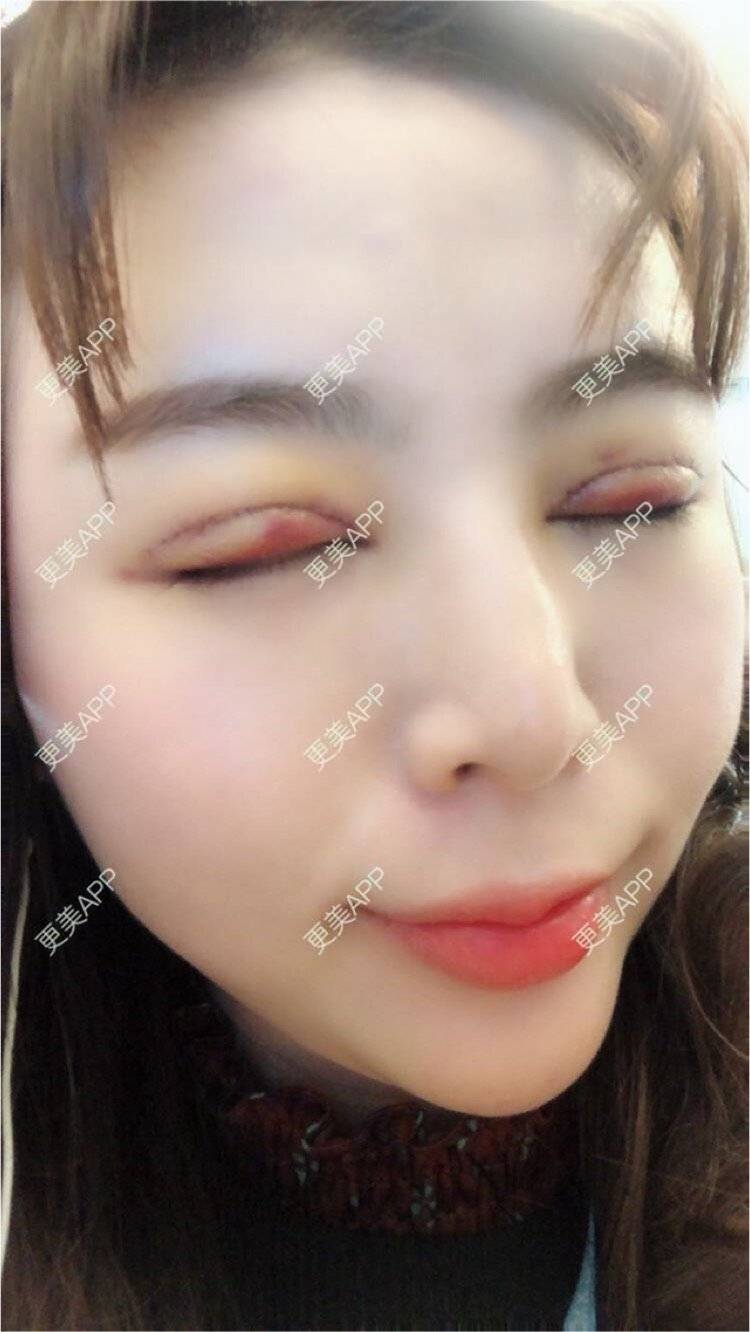 全切双眼皮效果图_小麦穗子全切双眼皮效果图_术后218天__更美