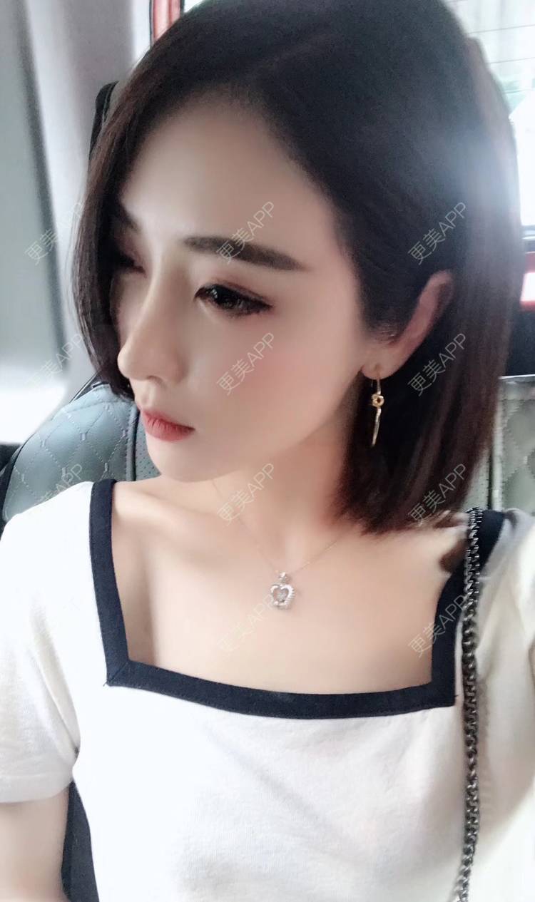 更美 - 莹莹D緈諨的鼻部多项经验 | 膨体隆鼻 | 视频日记 | 隆鼻 | 鼻部多项 | 广州 | 驼峰鼻矫正 | 鼻形态修复