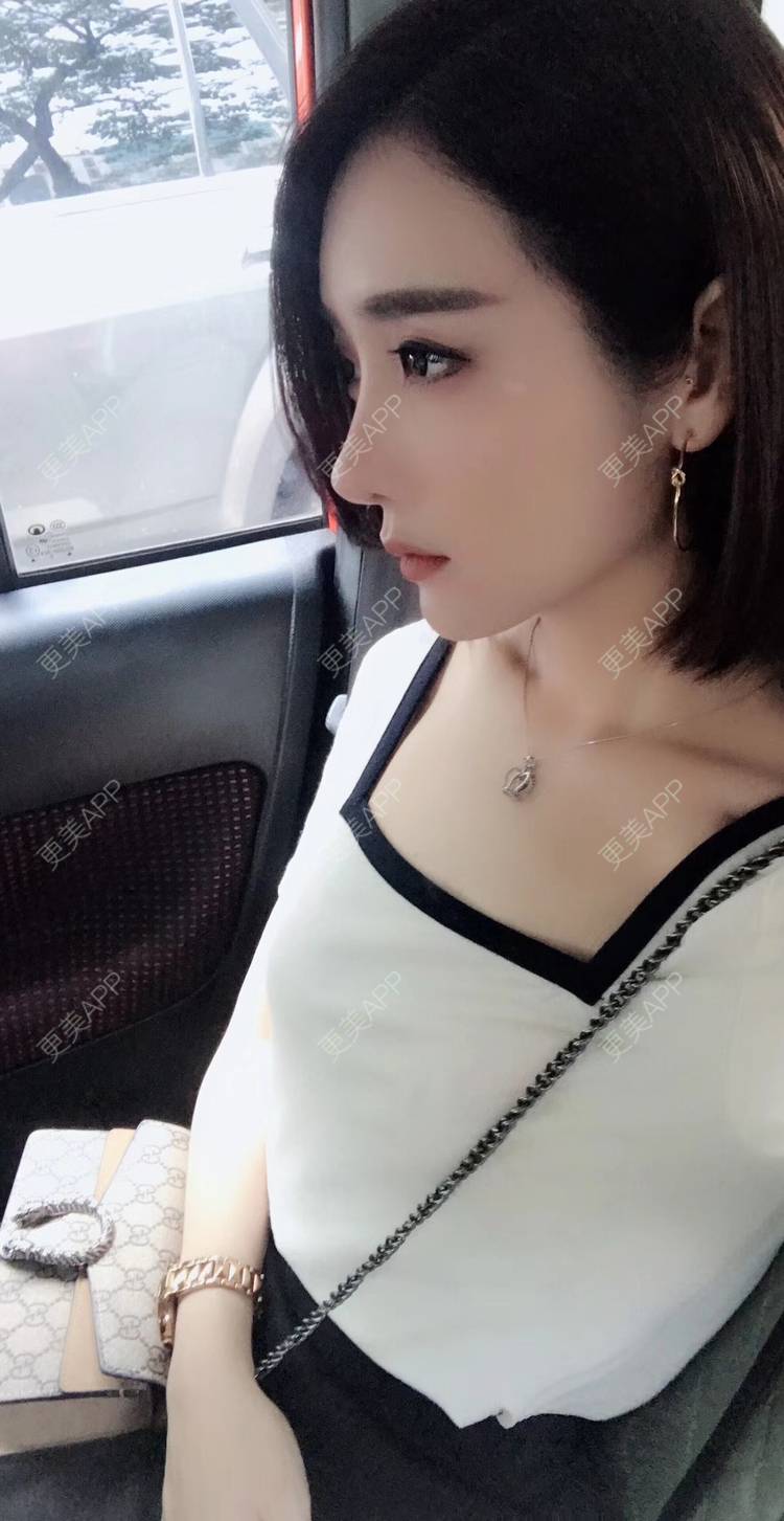 更美 - 莹莹D緈諨的鼻部多项经验 | 膨体隆鼻 | 视频日记 | 隆鼻 | 鼻部多项 | 广州 | 驼峰鼻矫正 | 鼻形态修复