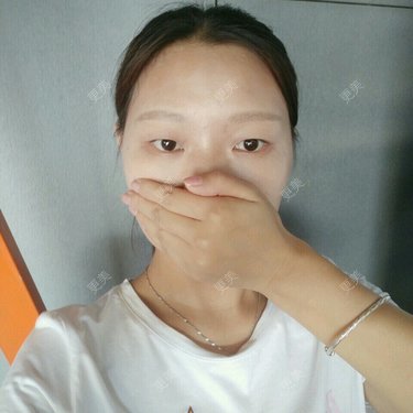 全切双眼皮