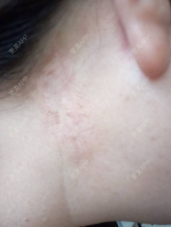 雨过天晴的激光淡疤日记