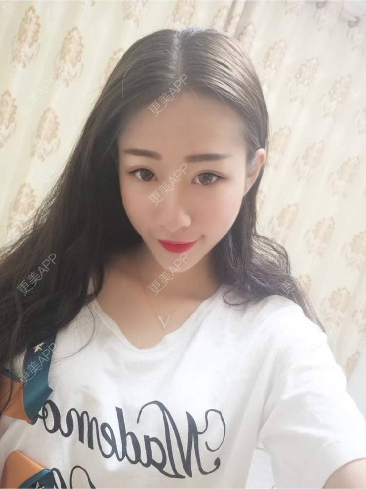 更美 - xlb💕的果酸焕肤经验 | 果酸焕肤 | 南宁