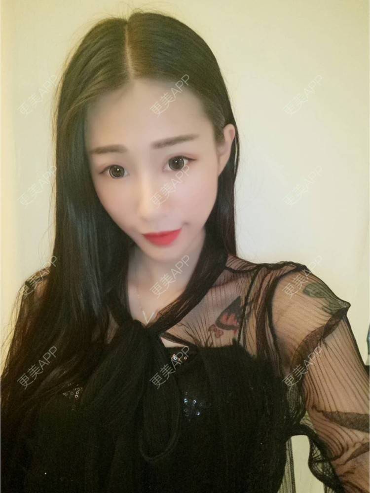 更美 - xlb💕的果酸焕肤经验 | 果酸焕肤 | 南宁