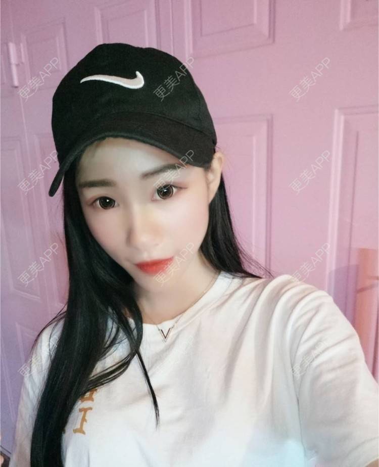 更美 - xlb💕的果酸焕肤经验 | 果酸焕肤 | 南宁