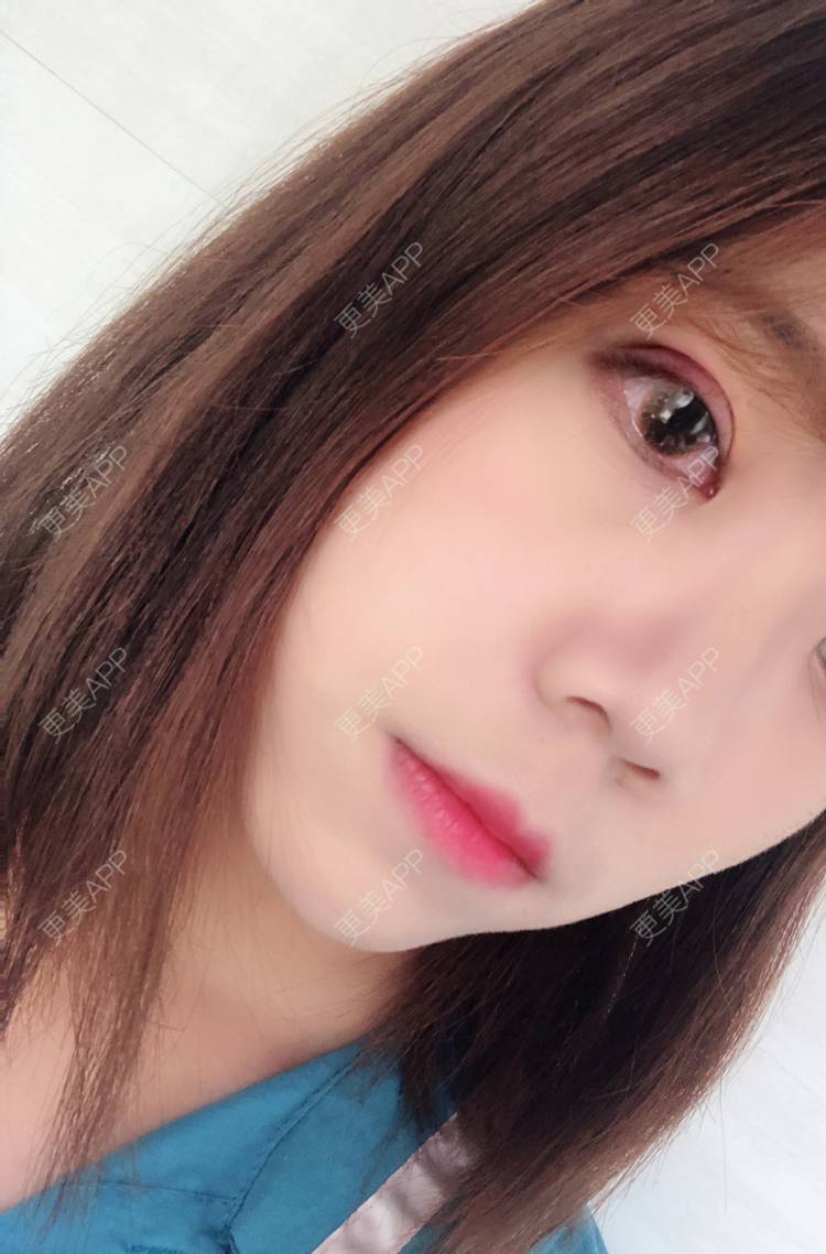 更美 - 武汉韩辰医疗美容医院的全切双眼皮经验 | 全切双眼皮