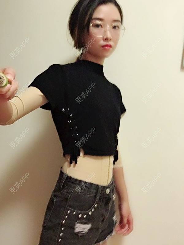 腰腹吸脂效果图_做自己的妩媚娘子腰腹吸脂效果图_术后37天__更美