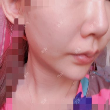 假体垫鼻基底