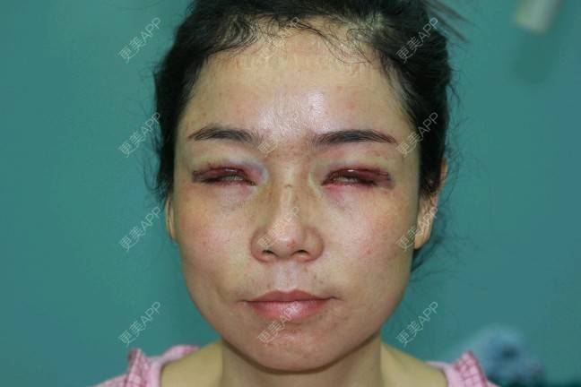 更美用户8lfwvxnrbj的眼皮下垂矫正日记