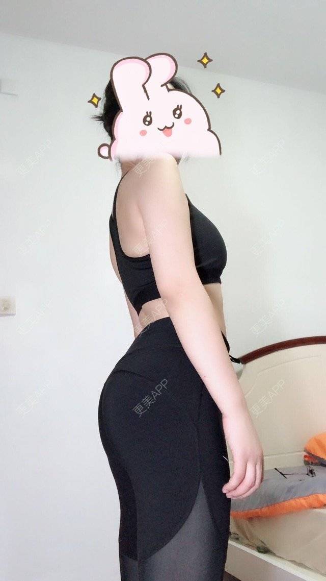更美 - 更美用户5NSwwHUH8w的自体脂肪丰臀经验 | 成都 | 自体脂肪丰臀